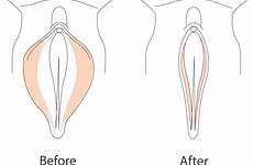 labia labial enlarged hypertrophy labiaplasty treatments