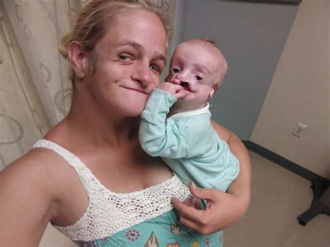 Craniofacial Vegan Treacher Collins Syndrome Zoey Tidwell Battles