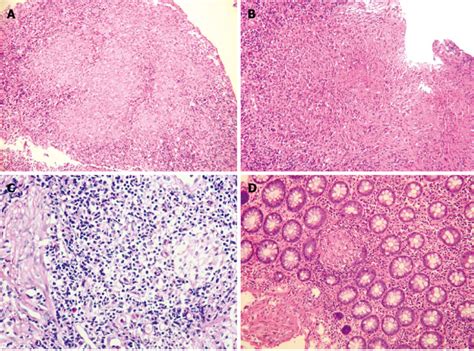 Histological Features A Confluent Granulomas In Inflammatory