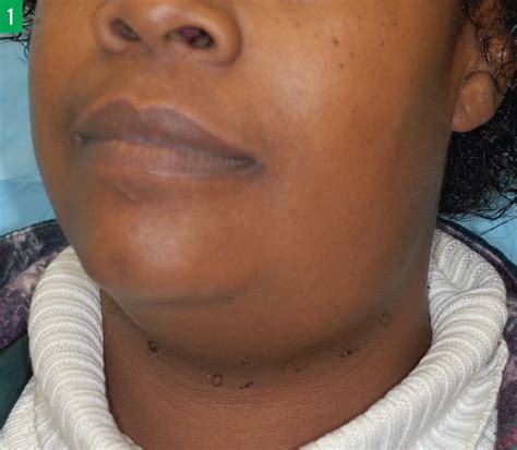 Swollen Salivary Glands Under Chin
