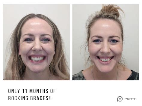 Adult Braces Before And After