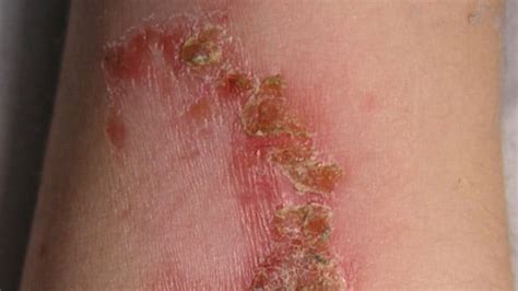 top 113 tipos de infecciones en la piel imagenes mx