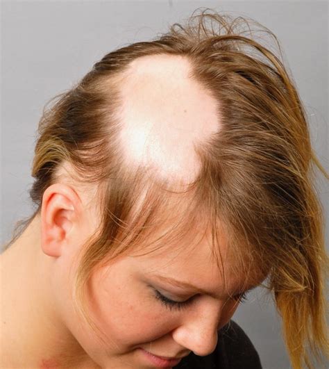 Tratamento Para Alopecia Areata Fernando Marques Clínica De