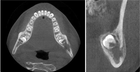 Cone Beam Ct Study Of A Case Of Eosinophilic Granuloma Of The Mandible