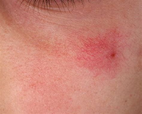 👉 Spider Angioma Symptoms Causes Pictures Treatment November 2021