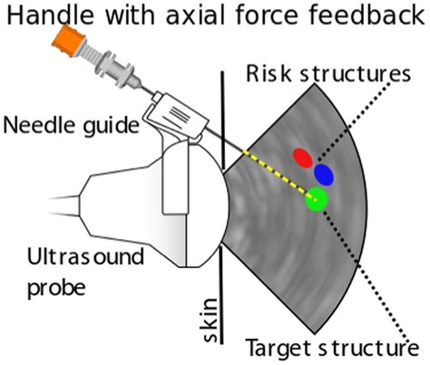 Schematic Overview Of Ultrasound Us Guided Needle Insertion Into The