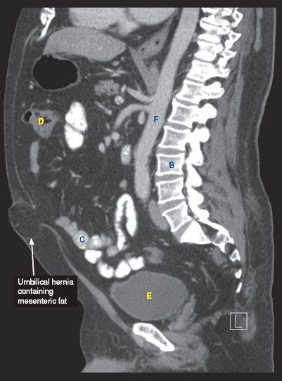 Hernias Radiology Key