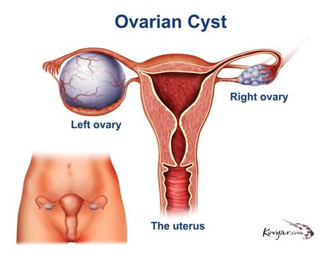 the real cause of ovarian cysts all potential
