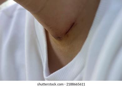 Thyroid Surgery Scar Images Stock Photos Vectors Shutterstock