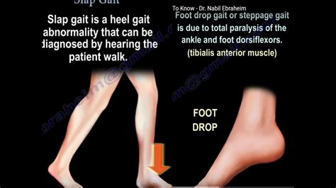 Slap Gait High Stepping Gait —