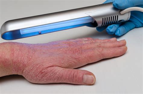 Phototherapy For Psoriasis