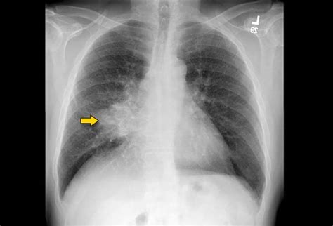 Nonsmall Cell Lung Cancer 5 Management Challenges