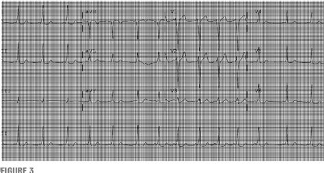 Figure 3 From Supraventricular Tachycardia In The Pediatric Trauma