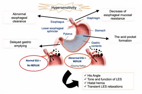 Cureus Gastroesophageal Reflux Disease Gerd Highlighting Diagnosis