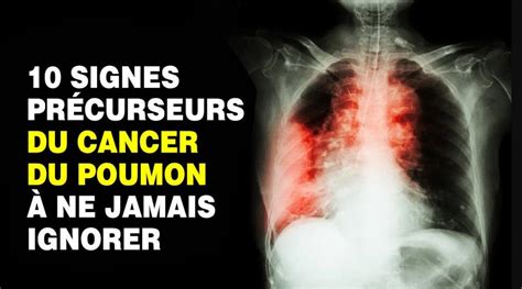 Symptomes Cancer Du Poumon Stade 1 - Communauté MCMS
