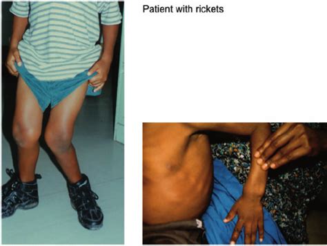 Two Patients With Drta And Rickets Download Scientific Diagram