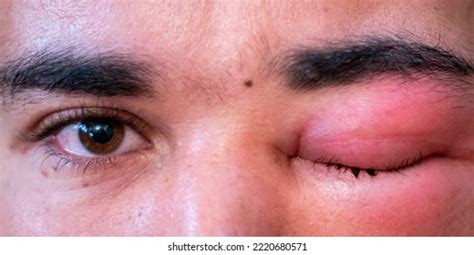 Adult Man Swollen Eye Bee Sting Stock Photo 2220680571 Shutterstock