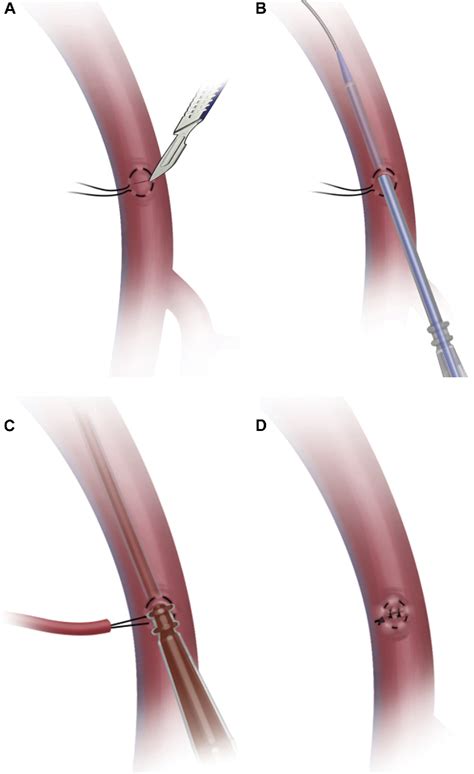 Figure 1 From Open Seldinger Guided Femoral Artery Cannulation