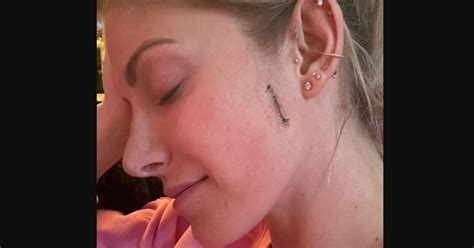 Wwe Star Alexa Bliss Reveals Stitches From Cancer Surgery Says Shes Lookin Like Frankenstein