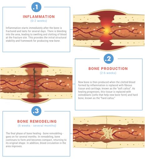 However, there are complex clinical conditions in which bone regeneration is required in large. Bone Fractures: The Phases of Healing, and How to Heal Faster