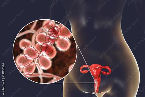 vaginal thrush female candidiasis 3d illustration showing fungal vaginitis and close up view