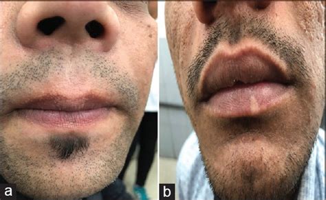 Mucoscopy Of Fordyces Spots On Lips Abstract Europe Pmc