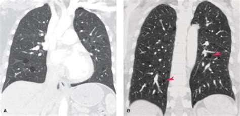 Diffuse Lung Disease Radiology Key