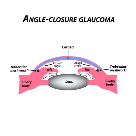 Chronic Angle Closure Glaucoma Eye Patient