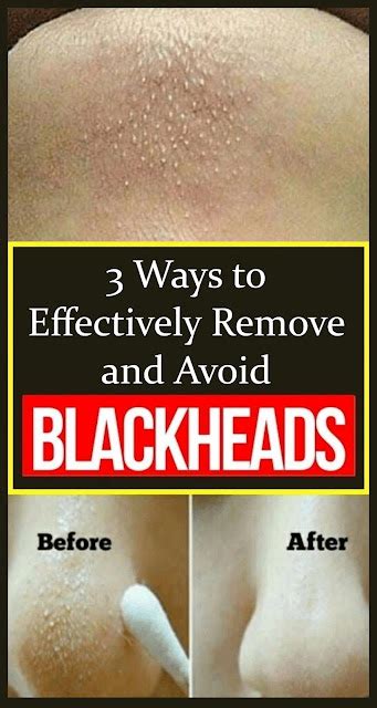 3 Ways To Effectively Remove And Avoid Blackheads Wellness Magazine