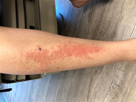 Raised Pink Rash On The Lower Extremity Clinical Advisor
