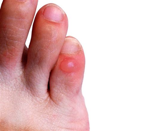 10 Ways To Make A Blister Heal Faster How To Treat Blisters Blisters