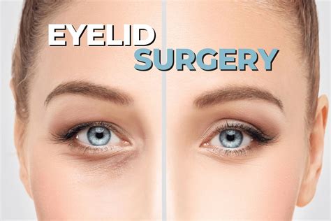 The Risks And Benefits Of Eyelid Surgery Ezontheeyes