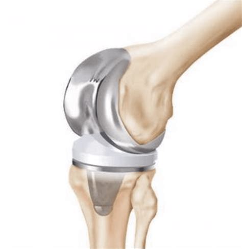 Revision Joint Replacement Surgery Midwest Center For Joint