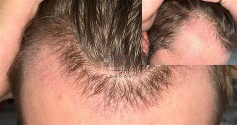 What You Need To Know About Shedding After A Hair Transplant