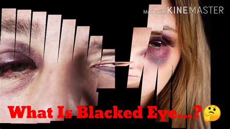 How To Get Rid Of Black Eyehematoma Through Home Remedies Youtube