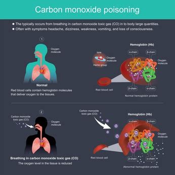 Jan 17, 2019 · behandlung: Kohlenmonoxidvergiftung - Ursachen, Beschwerden & Therapie ...