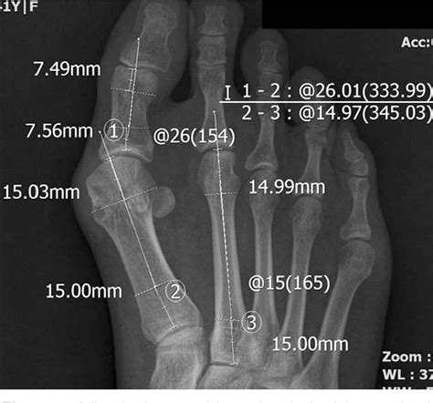 Figure 1 From Comparison Of Angle Measurements On Hallux Valgus With