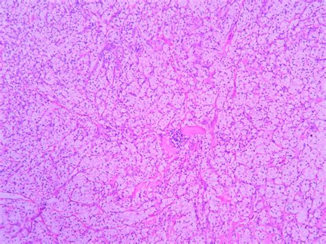 Renal Cell Carcinoma Ug Slide Histopathologyguru