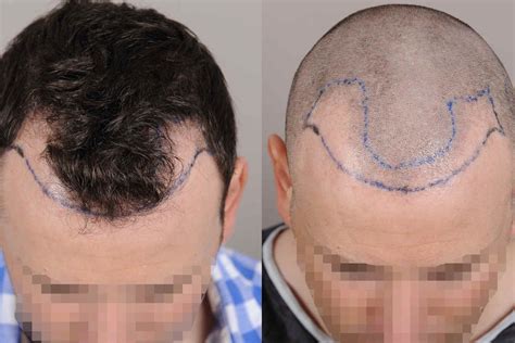 Methoden der Haartransplantation: [FUE- und FUT-Technik im Überblick]