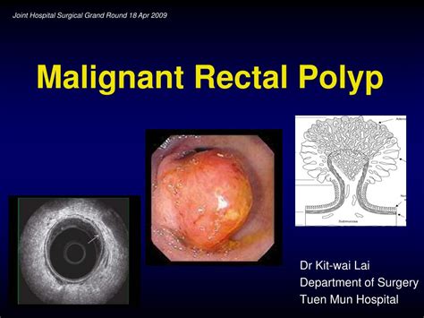 Ppt Malignant Rectal Polyp Powerpoint Presentation Id432580
