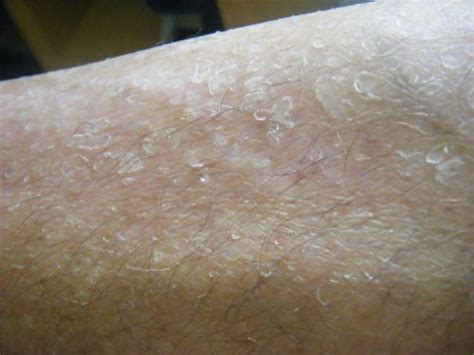 Eczema Pictures Pictures Of Eczema Natural Eczema Cure Revealed