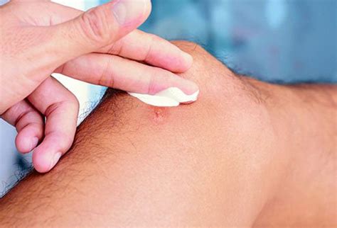 Black widow spider bites rarely kill people, but it's important to get medical attention as soon as black widow facts: Spider Bites: How Dangerous Are They?