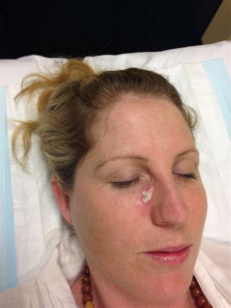 Skin Cancer Pictures Moles Symptoms Signs On Face Spots On Nose Photos
