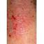 Eczema  Stock Image M150/0202 Science Photo Library