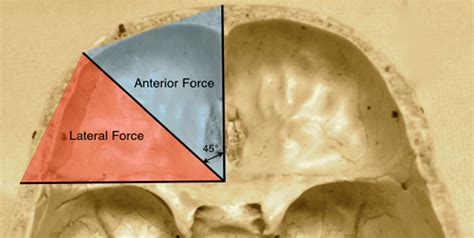 Applied Anatomy Of The Anterior Cranial Fossa What Can Fracture