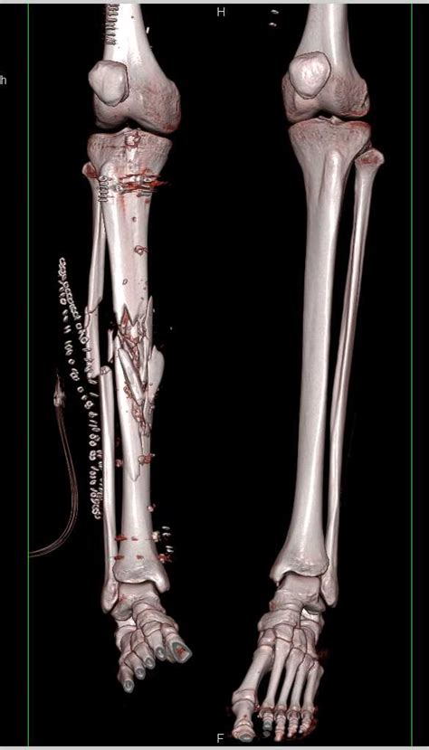 Orif Of Tibia And Fibular Fractures With Drain In Place And Soft Tissue