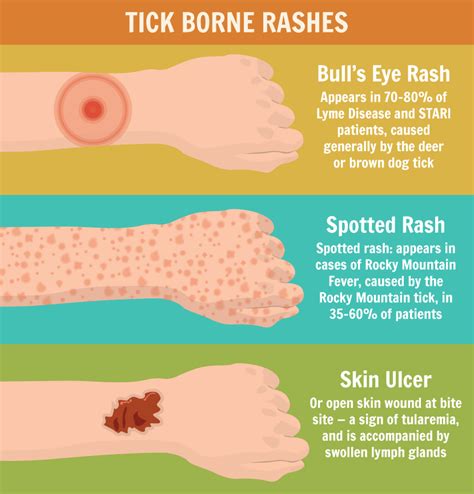 How To Prevent And Manage Tick Bites Infographic