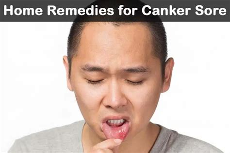 21 Diy Home Remedies For Canker Sore Wellnessguide
