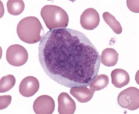 Chronic Myelomonocytic Leukemia 2