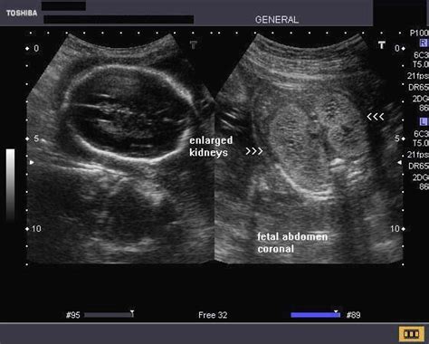 Fetal Polycystic Kidneys Ultrasound Fetal Medical Ultrasound
